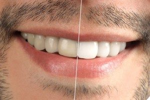 Blanqueamiento Dental