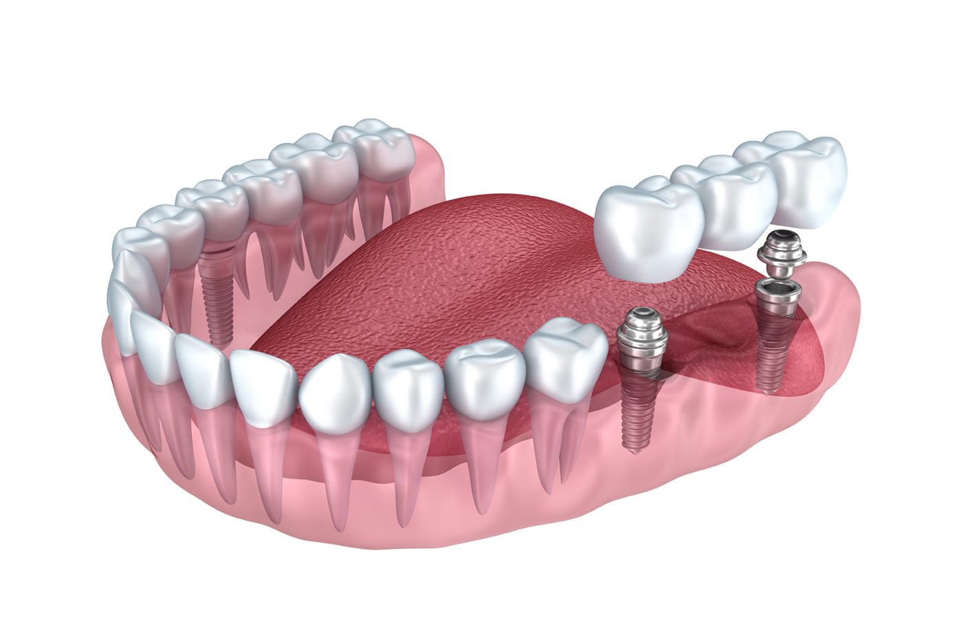 Puente dental
