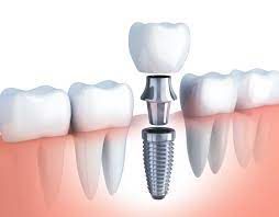Tratamientos de Odontología