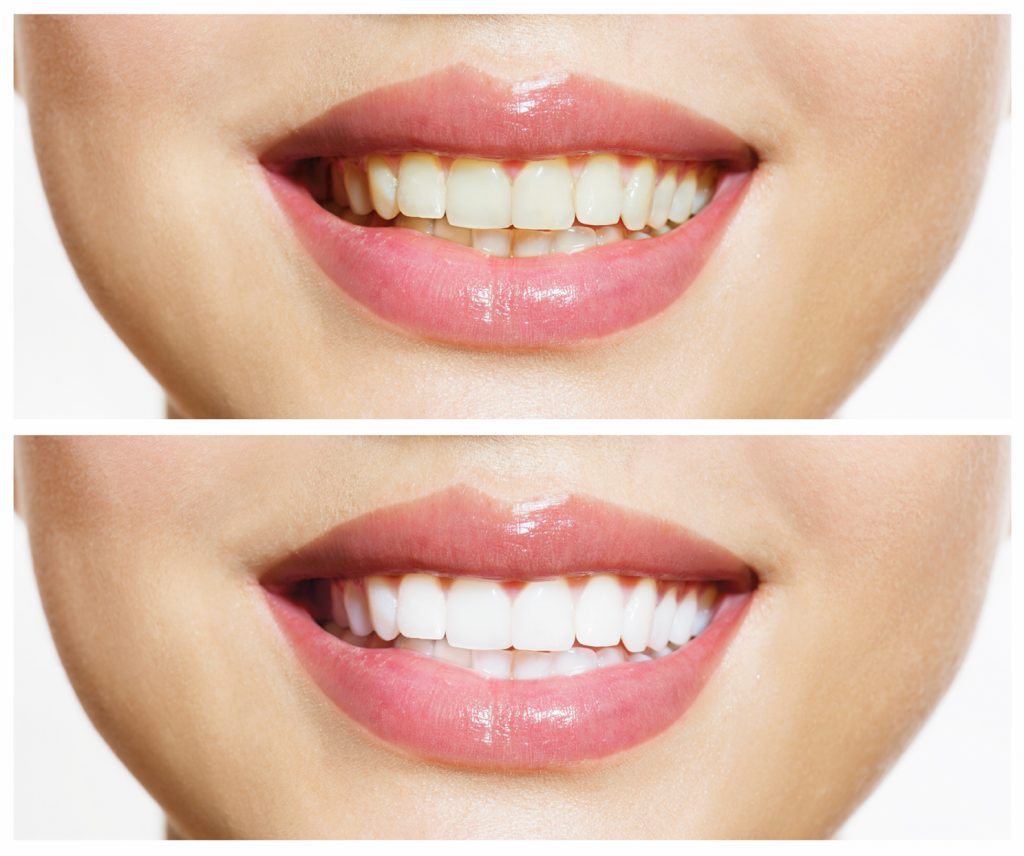 Blanqueamiento dental