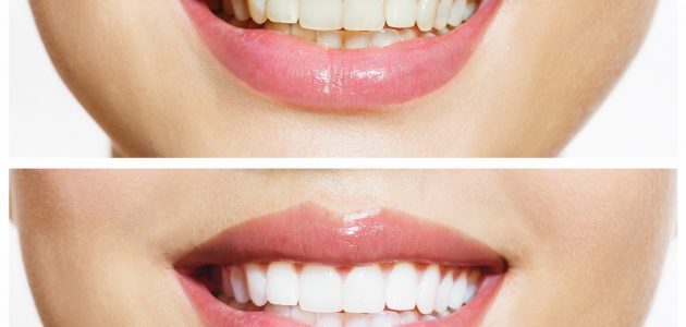 Blanqueamiento dental Pamplona