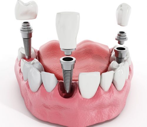 Coronas implantes