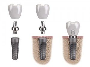 implantes dentales pampona precios